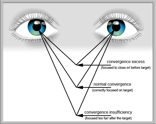 Convergence Excess & Insufficiency - Neuro-Vision Development Center